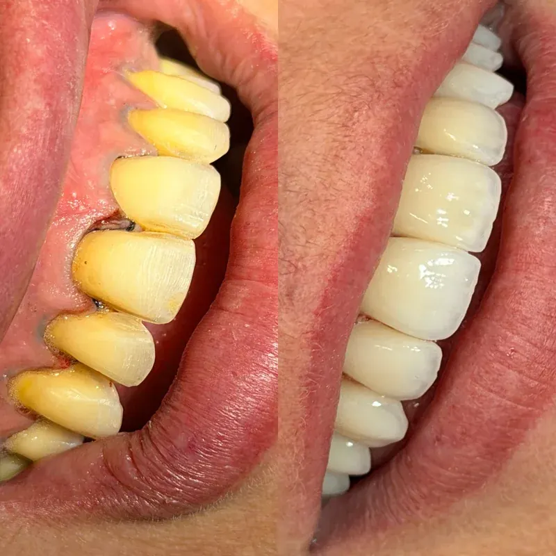 Caso 01 — antes e depois de clareamento dental na clínica Dra. Carmen Calixto, dentes amarelados à esquerda e branqueados à direita.