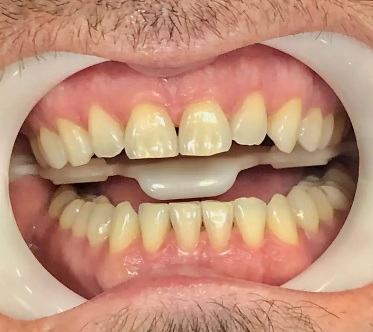 Antes do clareamento — dentes amarelados com afastador labial, paciente da Dra. Carmen Calixto.
