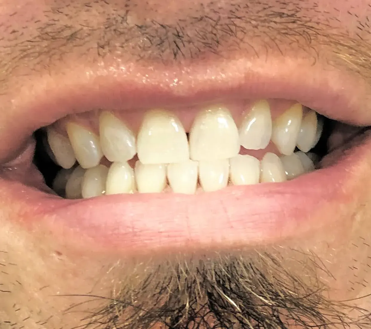 Depois do clareamento — dentes branqueados em sorriso natural, paciente da Dra. Carmen Calixto.