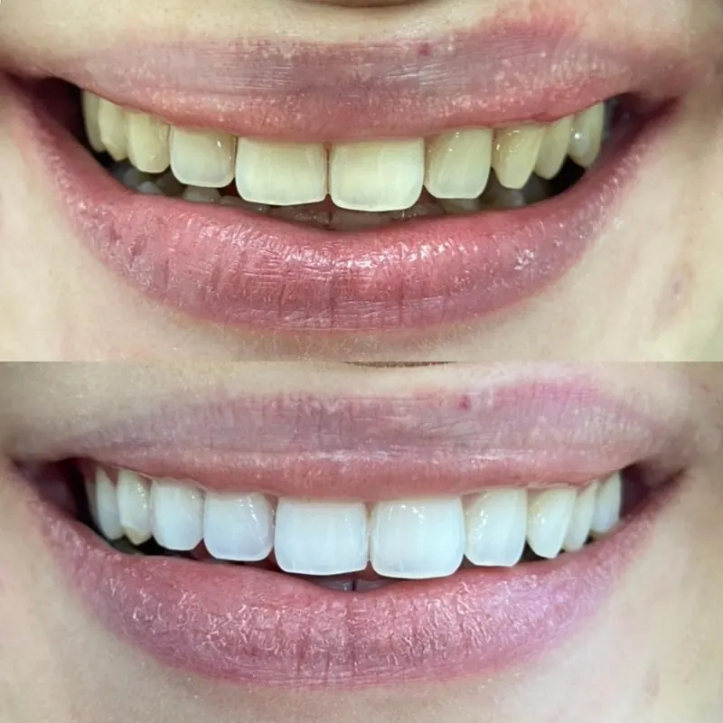 Caso 01 — antes e depois de clareamento dental na clínica Dra. Carmen Calixto.