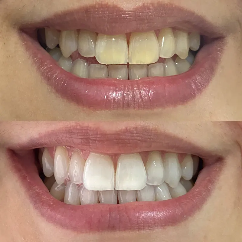 Caso 02 — antes e depois de clareamento dental na clínica Dra. Carmen Calixto.