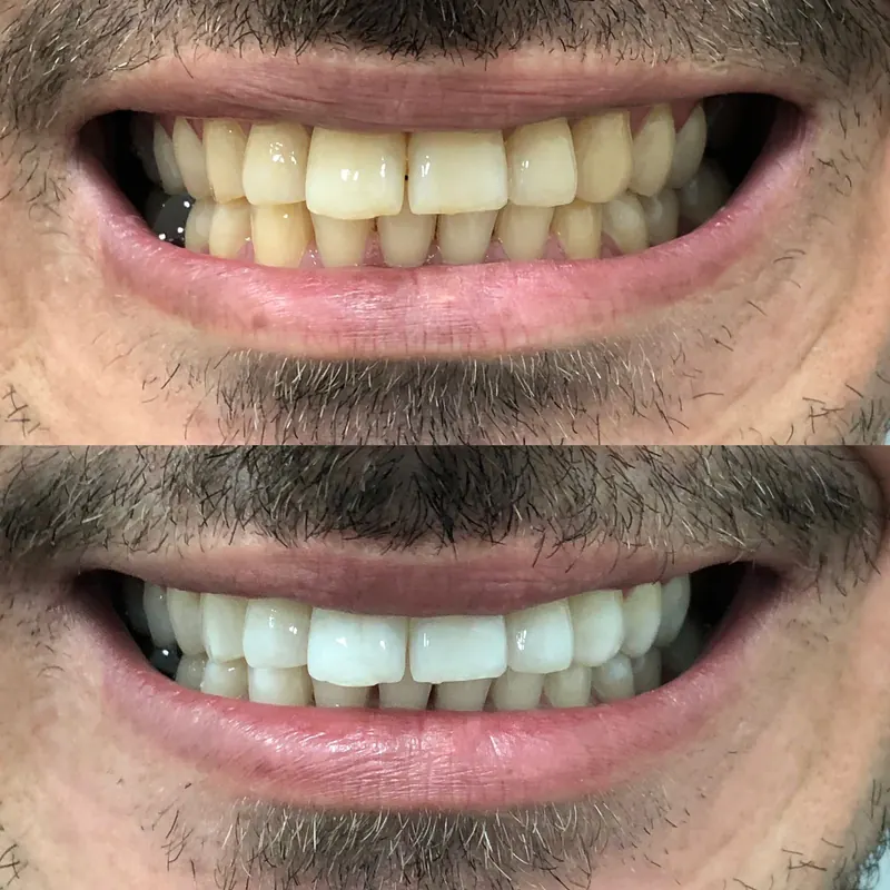 Caso 03 — antes e depois de clareamento dental na clínica Dra. Carmen Calixto.
