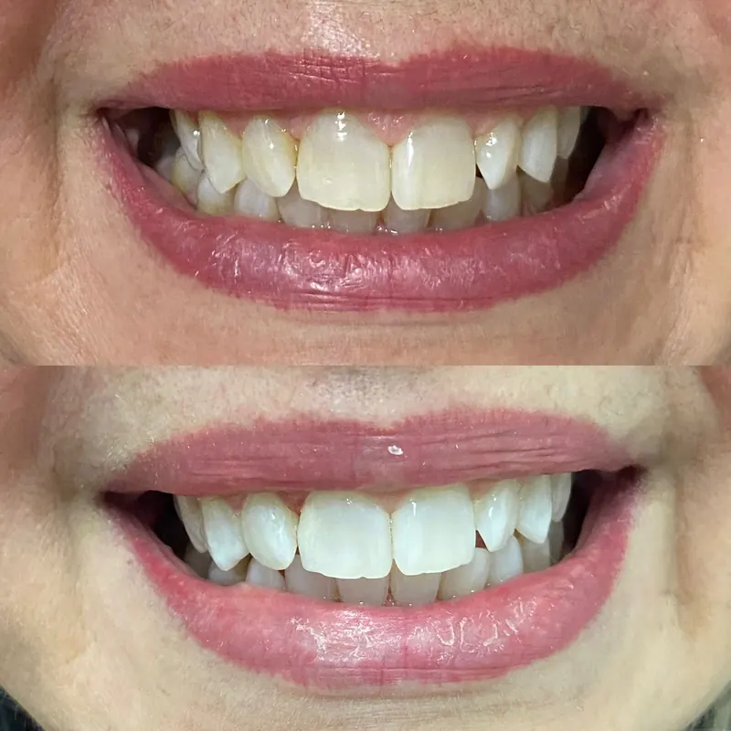 Caso 04 — antes e depois de clareamento dental na clínica Dra. Carmen Calixto.