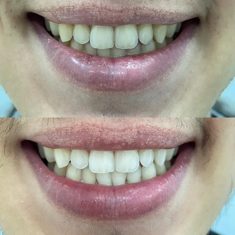 Caso 05 — antes e depois de clareamento dental na clínica Dra. Carmen Calixto.