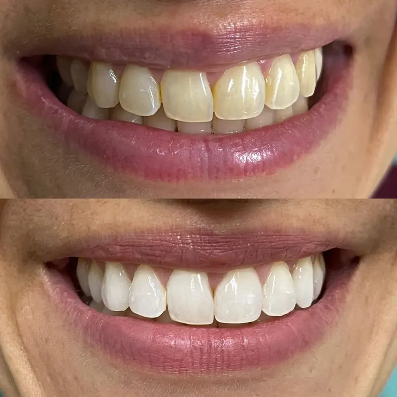Caso 06 — antes e depois de clareamento dental na clínica Dra. Carmen Calixto.