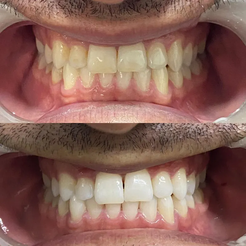 Caso 07 — antes e depois de clareamento dental na clínica Dra. Carmen Calixto.