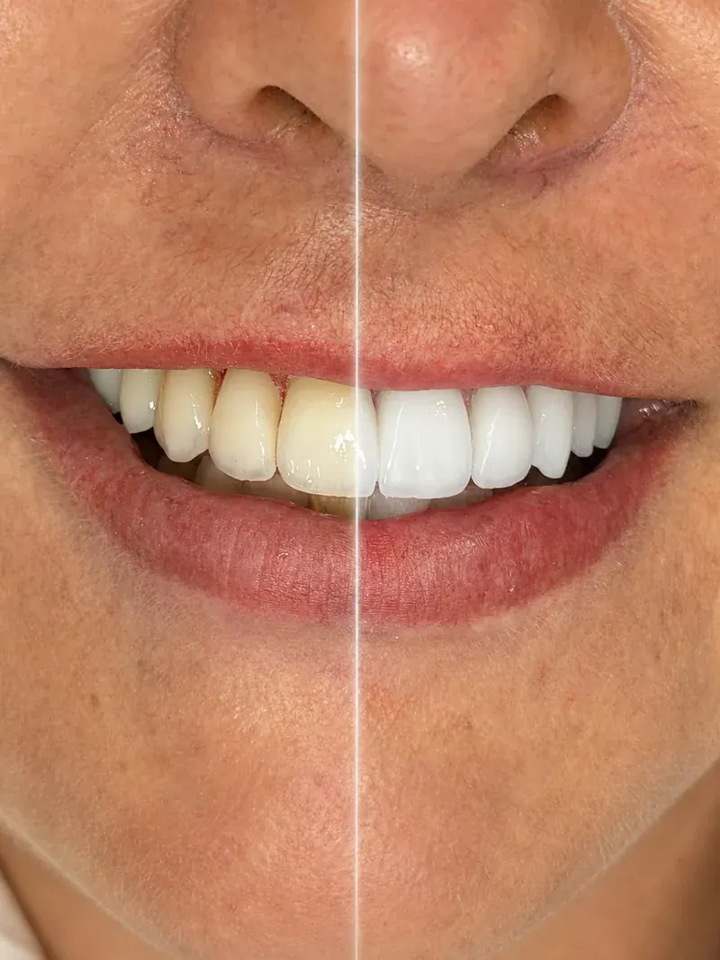 Antes e depois de clareamento dental do paciente Henrique, atendido pela Dra. Carmen Calixto — lado esquerdo com dentes naturalmente amarelados, lado direito com dentes branqueados.