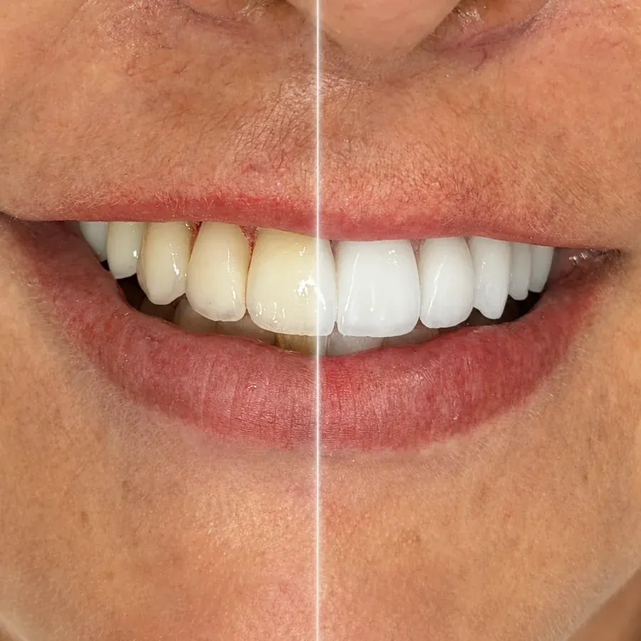 Caso 03 — antes e depois de clareamento dental na clínica Dra. Carmen Calixto, sorriso com split vertical de dentes amarelados e branqueados.